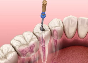 https://uniquedentalclinicfaridabad.com/wp-content/uploads/2021/04/Endodontics.jpg