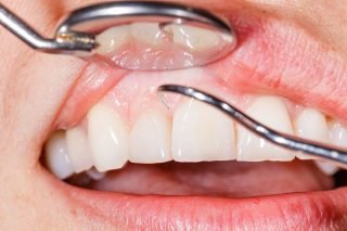 https://uniquedentalclinicfaridabad.com/wp-content/uploads/2021/04/Receding-gum-line-320x213.jpg